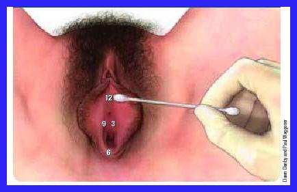 Diagnosi di Vulvodinia • VULVODINIA.INFO Swab-test